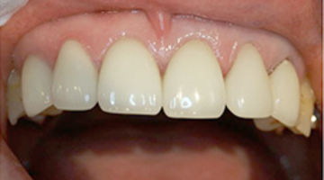 STEP05　調整・装着