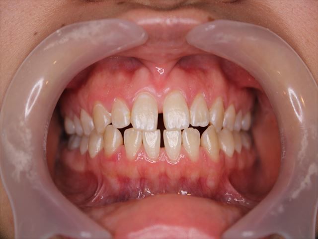 ダイレクトボンディング