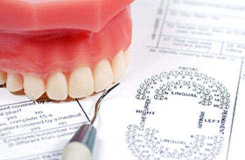 ラミネートベニア